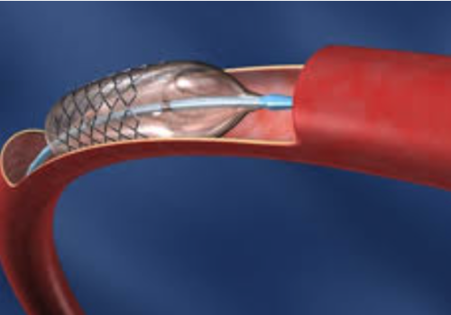 cirurgia_endovascular